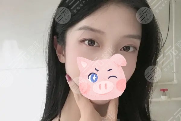 納米微創(chuàng)雙眼皮保持多久