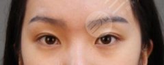 雙眼皮失敗的八種表現(xiàn)分別有哪些？雙眼皮失敗的八種圖片