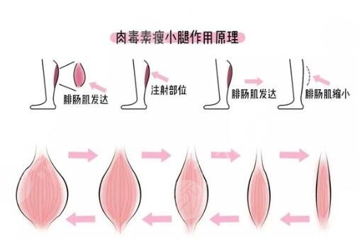 瘦?腿價格與求美者有關　