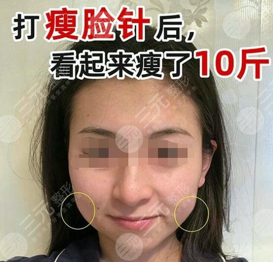 打注射瘦臉術(shù)后的注意事項