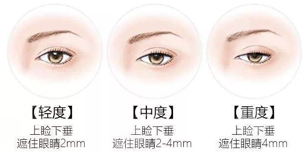 眼皮松弛怎么辦？愛美者一定要引起足夠的重視！