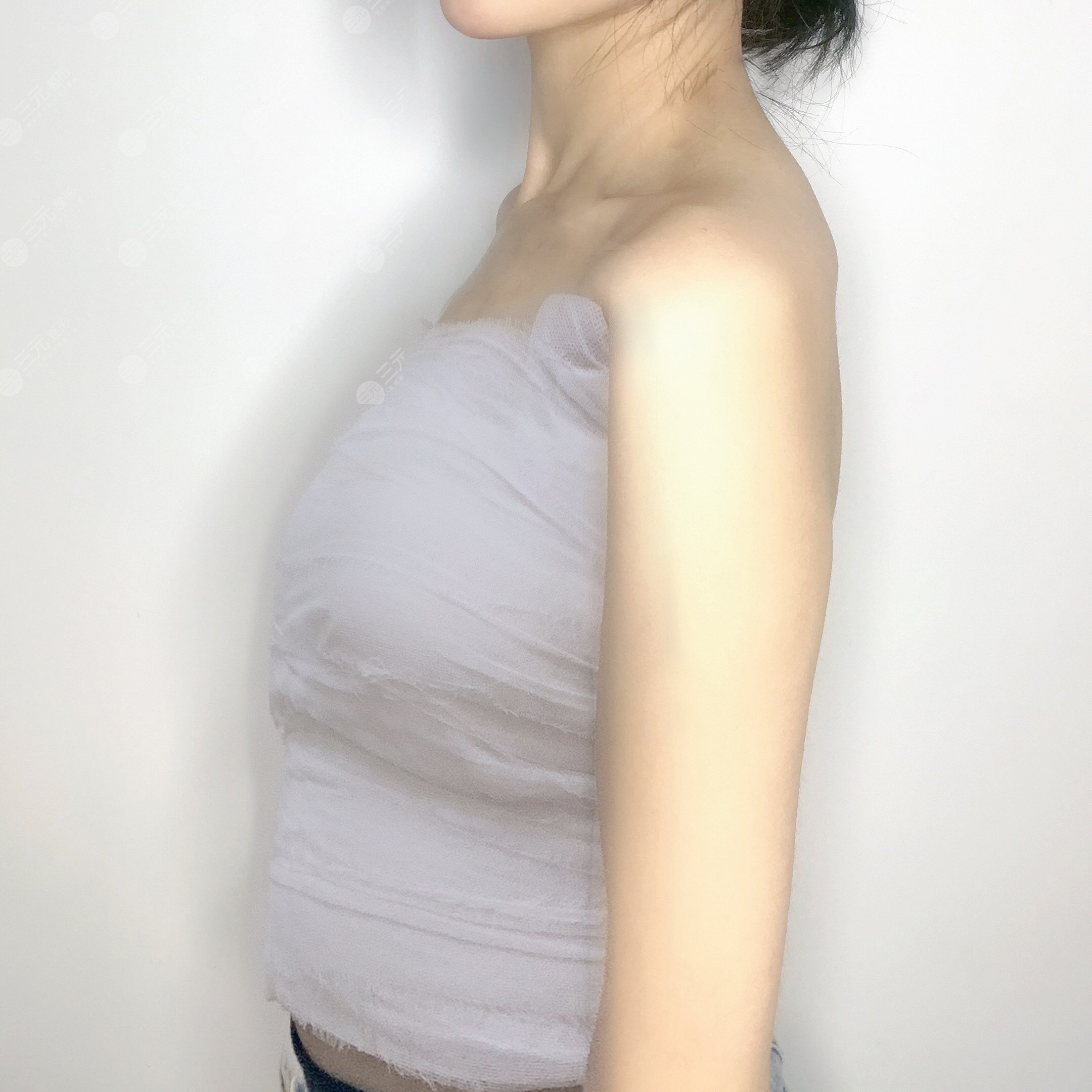 乳房縮小術(shù)前后對(duì)比,看了你就相信杭州美來(lái)比較好!