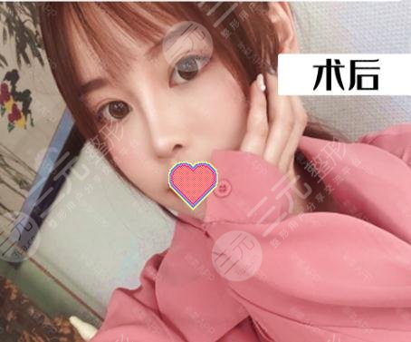 鼻翼縮小術后三個月