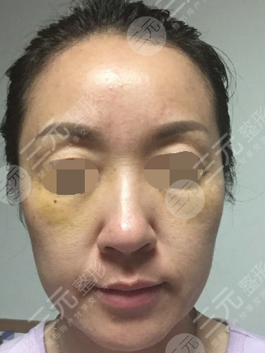 面部年輕化plus全臉，快速解決面部問題，內(nèi)附真實(shí)案例分享圖