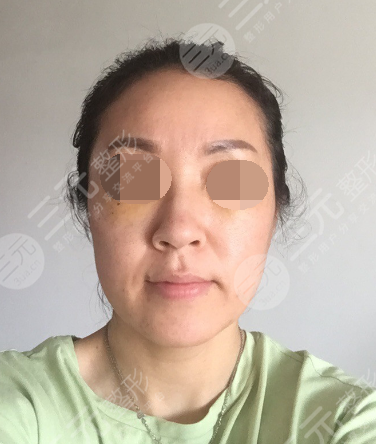 面部年輕化plus全臉，快速解決面部問題，內(nèi)附真實(shí)案例分享圖