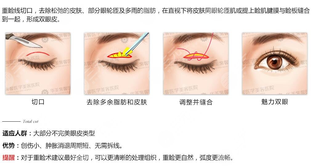 微創(chuàng)雙眼皮需要多少錢