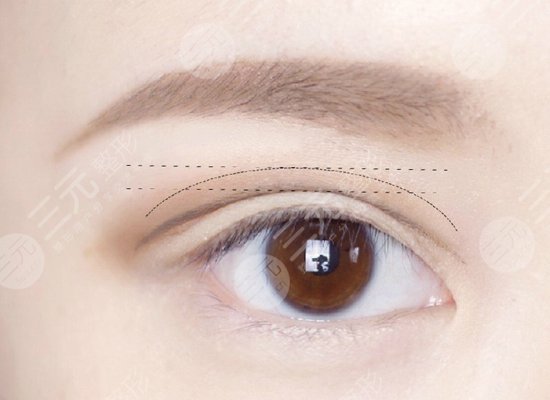 微創(chuàng)雙眼皮需要多少錢