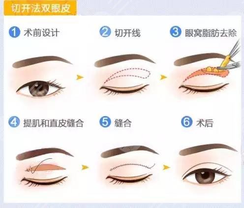 開眼角9mm平行雙眼皮，注意事項(xiàng)+體驗(yàn)測評大公開！