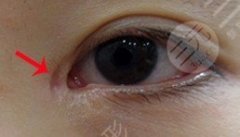 開眼角后疤痕增生怎么辦？愛美的仙女們千萬別錯(cuò)過了！