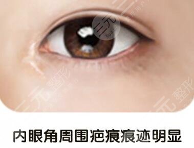 開眼角疤痕增生