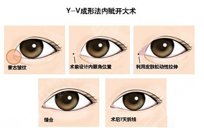 開眼角疤痕增生解決辦法