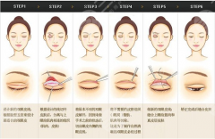 雙眼皮全切過程講解！手術(shù)之前可以深入了解，做好變美準(zhǔn)備！