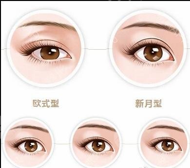 雙眼皮腫消了還會變窄嗎？科普解答，一起來看看是怎么回事吧！