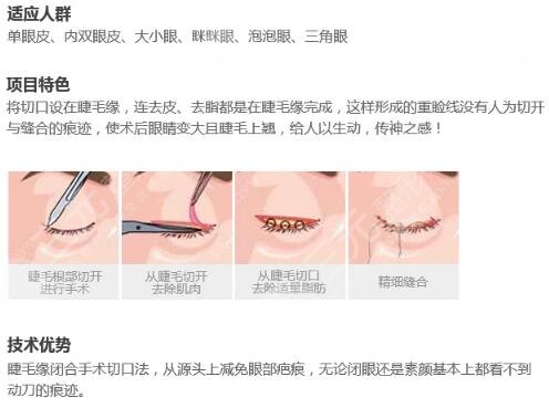 保持多久,納米微創(chuàng),雙眼皮,