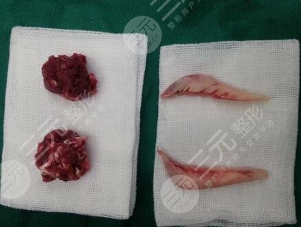 手術(shù)中損傷神經(jīng)