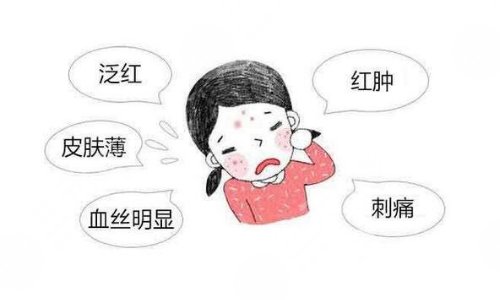 怎么去臉上的紅血絲