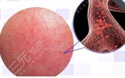 怎么去臉上的紅血絲