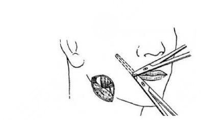 如何讓咬肌變??？