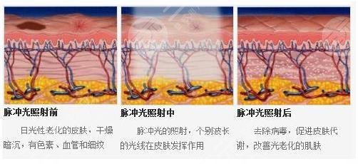 光子嫩膚術(shù)操作流程
