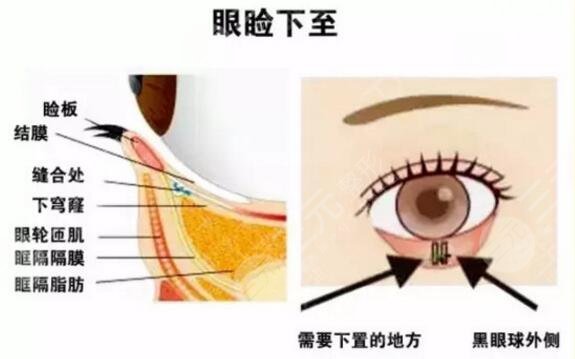 眼瞼皮膚松弛矯正風(fēng)險(xiǎn)