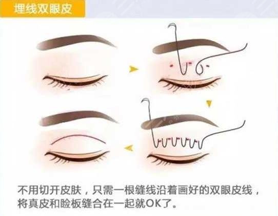 埋線雙眼皮一到7天圖片分享，附埋線雙眼皮恢復(fù)圖片過(guò)程