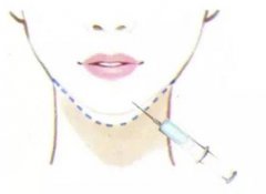 墊下巴比較適合哪些人做？墊下巴適宜人群|真實(shí)墊下巴案例