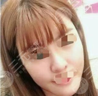 真實墊下巴后1個月