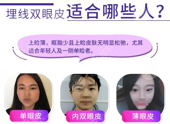 雙眼皮埋線適合的人群