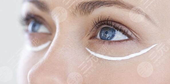 眼瞼皮膚松弛矯正術(shù)手術(shù)注意事項(xiàng)
