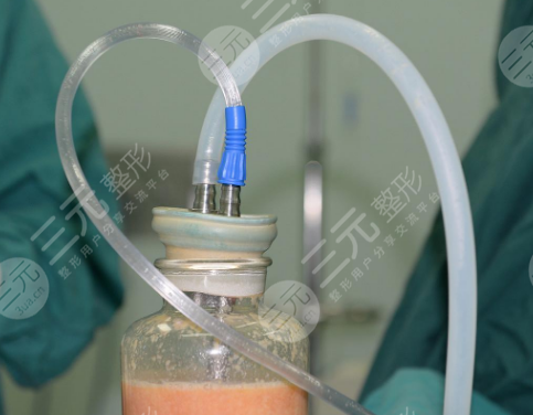 威塑抽脂和水動力吸脂的副作用