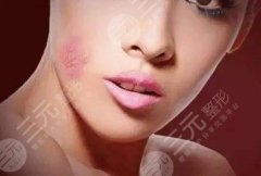 激光去除紅血絲多少錢？激光去紅血絲整形案例果記錄！