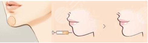 注射豐下巴6大好處