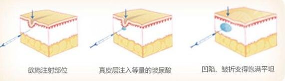 注射玻尿酸豐下巴的果如何