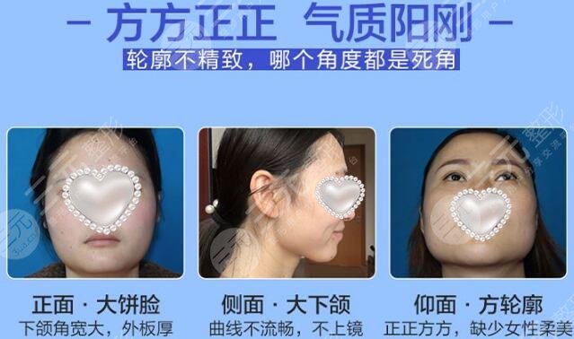 下頜骨截骨手術(shù)費(fèi)用揭秘！貴嗎？術(shù)后注意什么？科普一看便知！