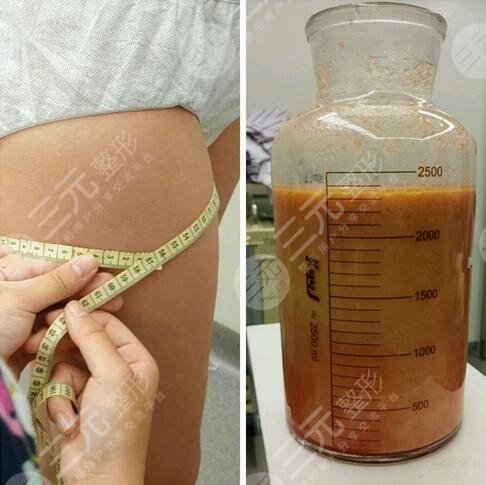 威塑抽脂和水動力吸脂相同之處