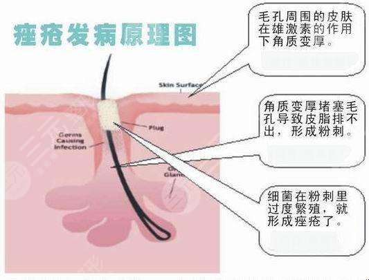 顴骨長(zhǎng)痘怎么辦