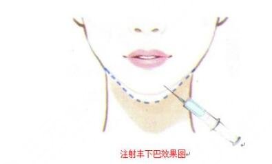 玻尿酸豐下巴是什么