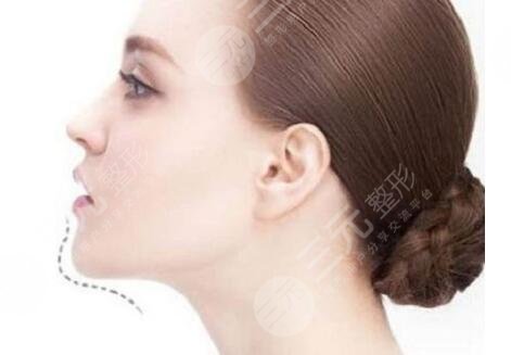 玻尿酸注射下巴能維持多久