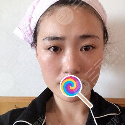 九院韋敏綜合鼻案例