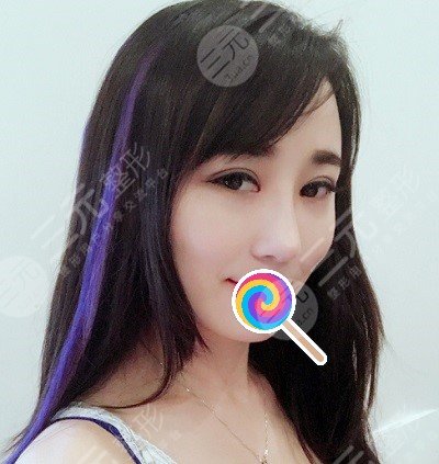 九院韋敏綜合鼻案例