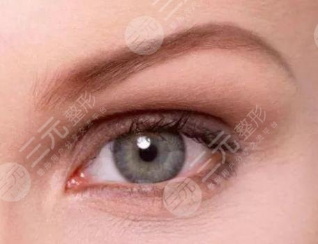 什么是歐式雙眼皮