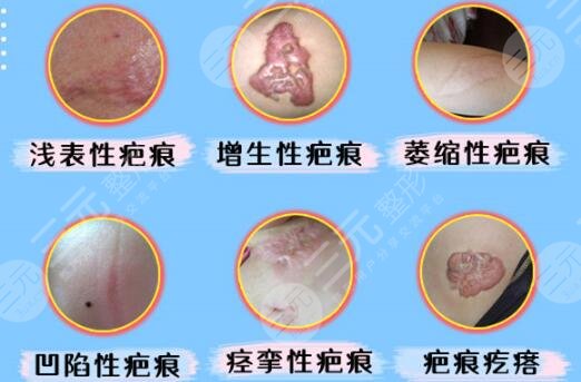 祛痘除疤手術(shù)多少錢？點陣激光幫你搞定，科普講解看看！