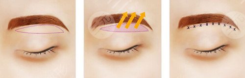 提眉術價格一般是多少