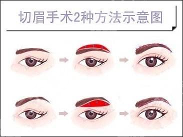 提眉術價格一般是多少