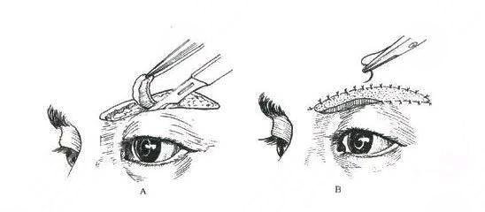 提眉術價格一般是多少