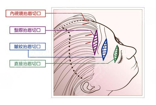 提眉術價格一般是多少