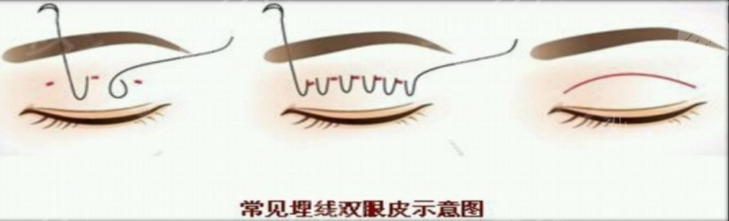 埋線雙眼皮