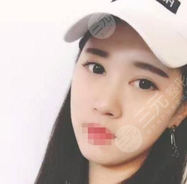 開(kāi)眼角整形后6周