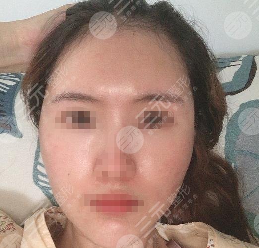 西安西京醫(yī)院整形美容科面部脂肪填充過程