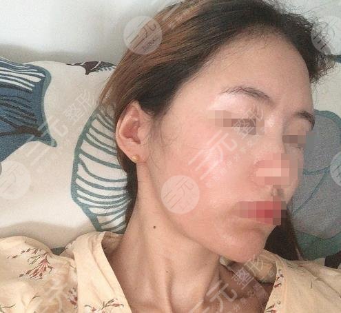 西安西京醫(yī)院整形美容科面部脂肪填充過程